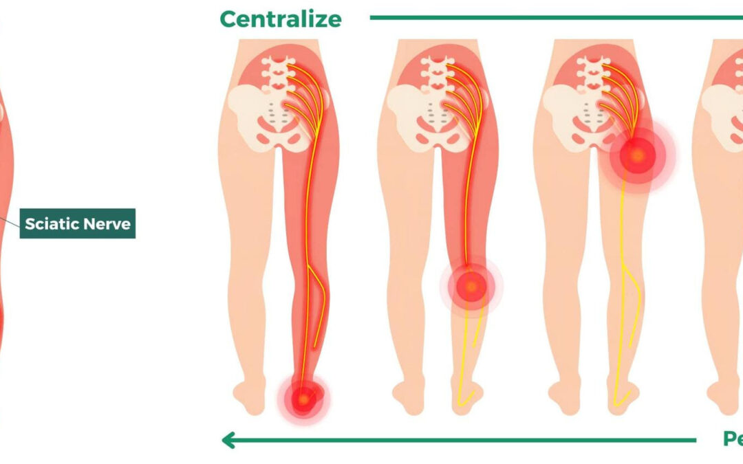 Sciatica… Is that what my leg pain is?