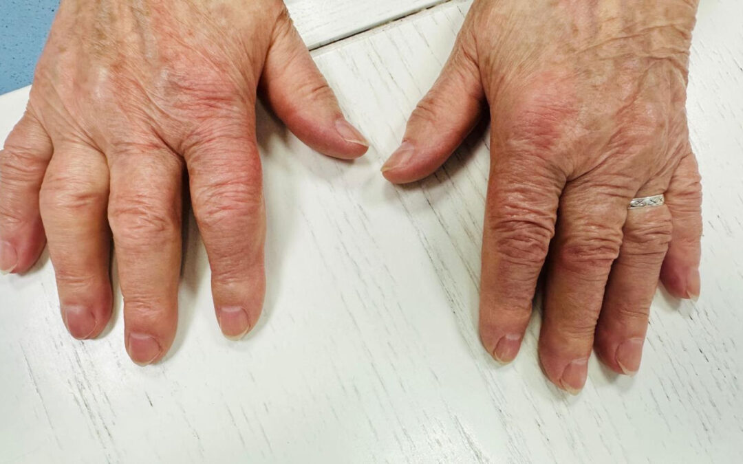 Osteoarthritis vs. Autoimmune Arthritis: What Most People Get Wrong and How to Take Control Naturally